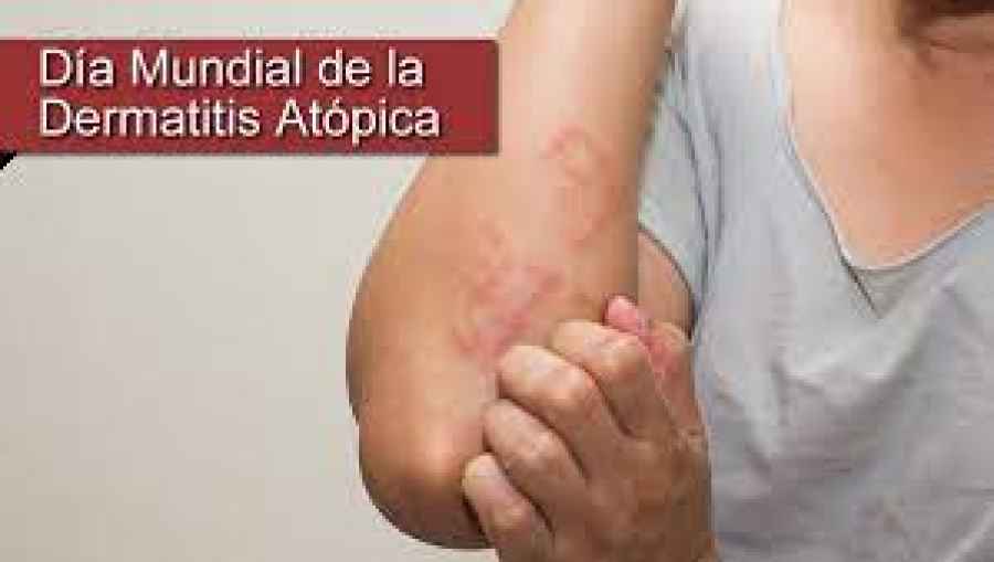 D&iacute;a Mundial de la Dermatitis At&oacute;pica