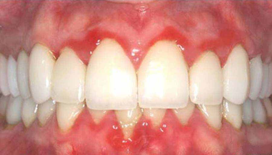 Mujeres con gingivitis cr&oacute;nica tienen m&aacute;s chances de padecer c&aacute;ncer