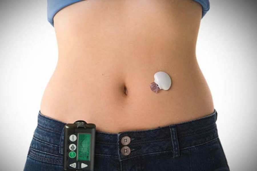 Exitoso funcionamiento del p&aacute;ncreas artificial argentino