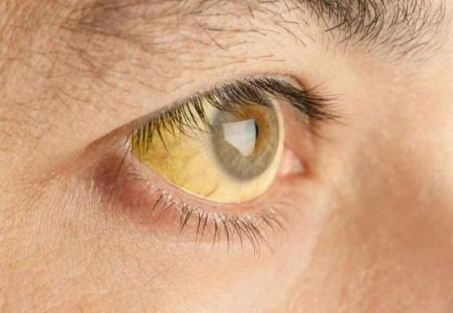 Preocupan en Argentina los nuevos casos de Hepatitis A y B y la falta de diagn&oacute;stico de Hepatitis C