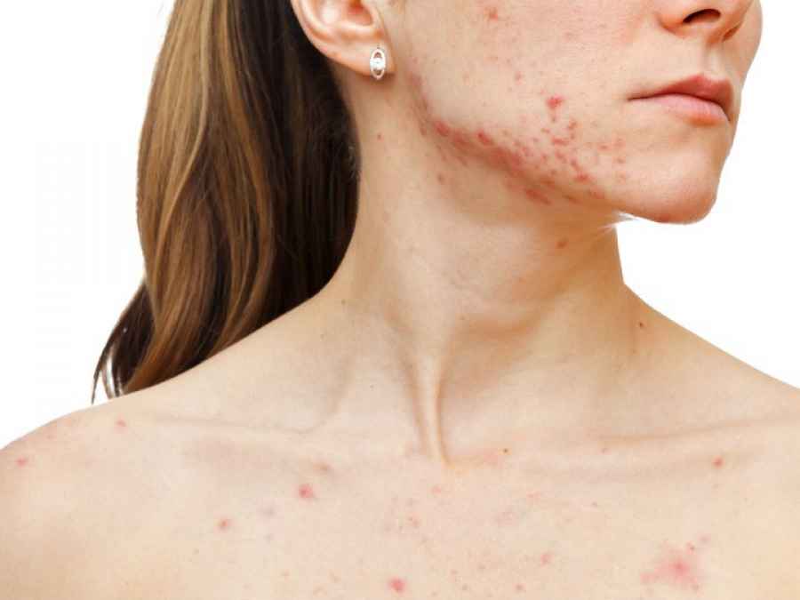 Confirmaci&oacute;n de caso de sarampi&oacute;n en turista: alto riesgo de diseminaci&oacute;n