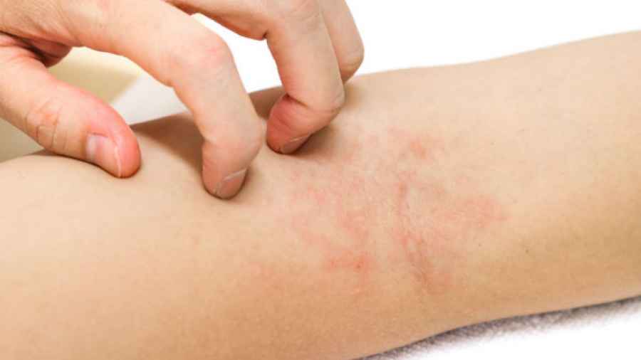 Campa&ntilde;a de detecci&oacute;n gratuita de Dermatitis At&oacute;pica