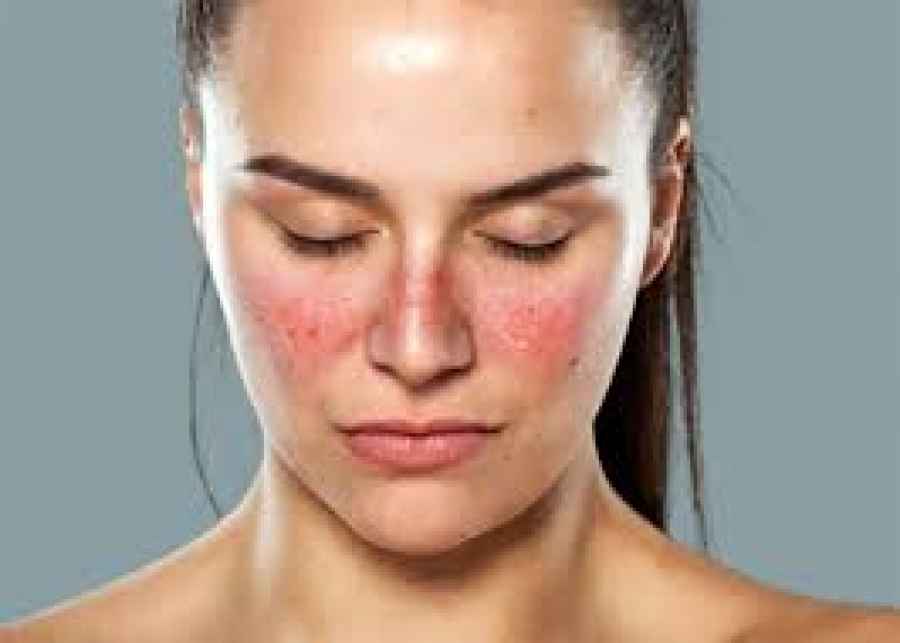 VGLL3, la mol&eacute;cula que hace que las mujeres sean m&aacute;s propensas a contraer lupus