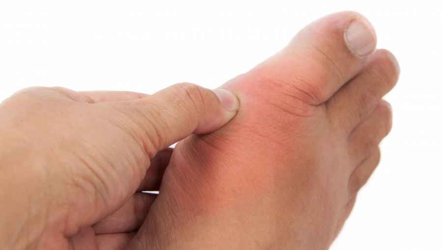 En investigaci&oacute;n: nueva terapia preventiva para la gota