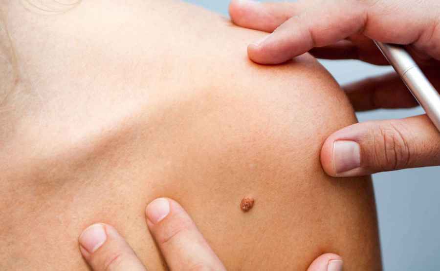 &ldquo;Los lunares est&aacute;n de moda&rdquo;