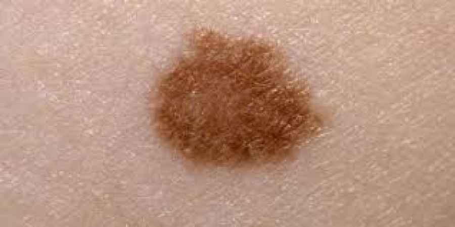 Se trata de la introducci&oacute;n en un sistema a escala nanom&eacute;trica &ndash;algo tan infinitamente peque&ntilde;o como la mil millon&eacute;sima parte de un metro&ndash; de una droga oncol&oacute;gica que ya est&aacute; en uso, para permitir que en un futuro pueda administrarse en una formulaci&oacute;n t&oacute;pica.