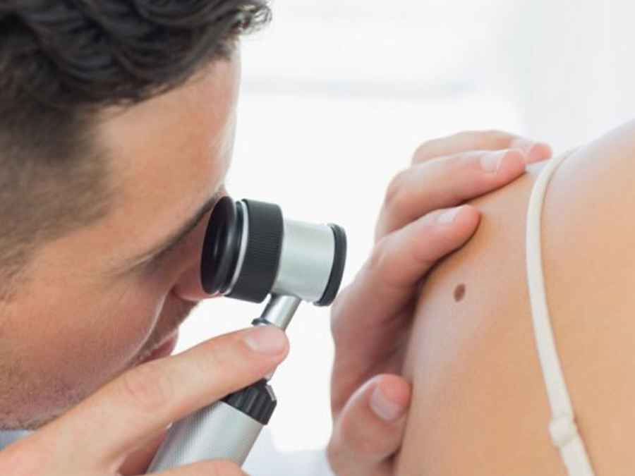 Bristol Myers Squibb y LALCEC para brindar controles gratuitos de lunares