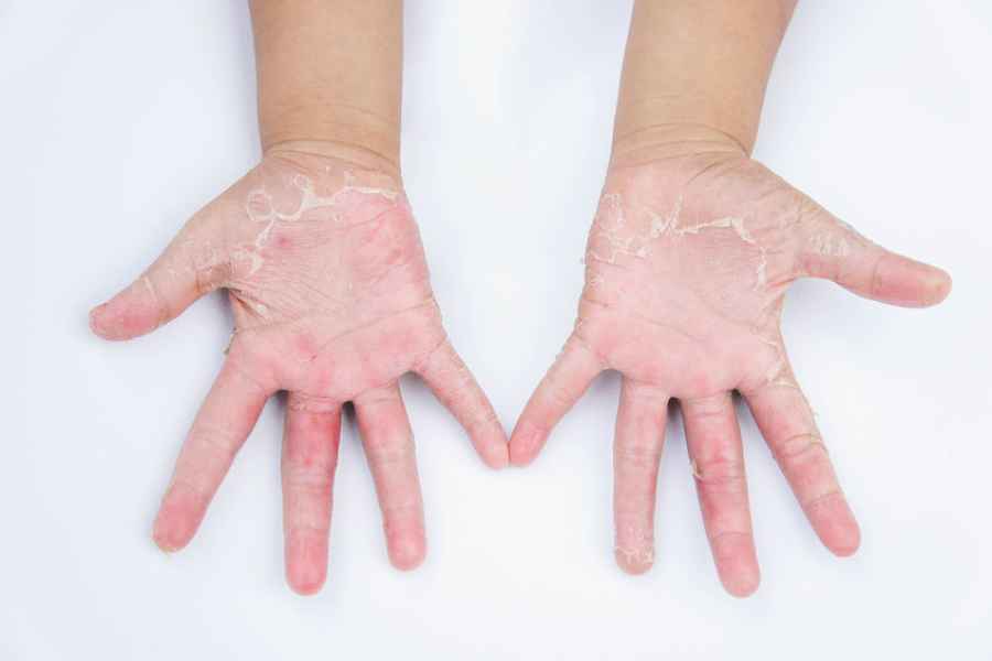 Impacto de la dermatitis at&oacute;pica en ni&ntilde;os