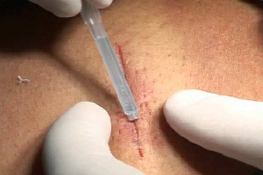 Un hidrogel es capaz de sellar de manera eficiente y definitiva las lesiones en &oacute;rganos y tejidos sin tener que recurrir a las grapas y puntos quir&uacute;rgicos.