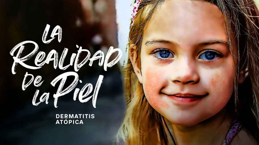 Pfizer presenta dos nuevos tratamientos para la dermatitis at&oacute;pica