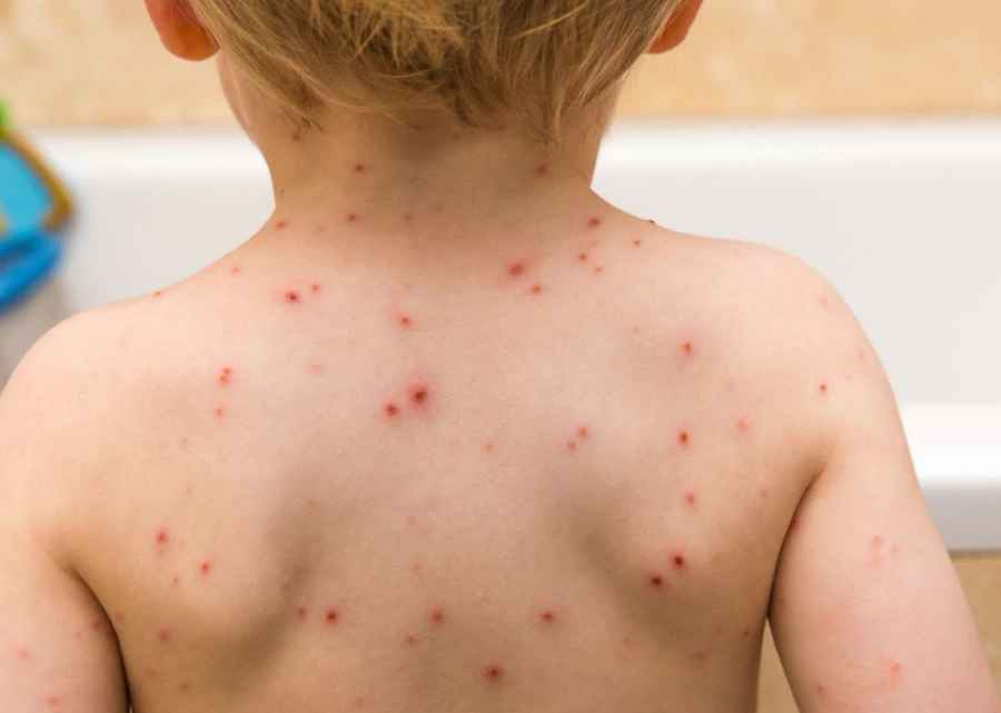 Alerta epidemiol&oacute;gica: 61 casos de sarampi&oacute;n