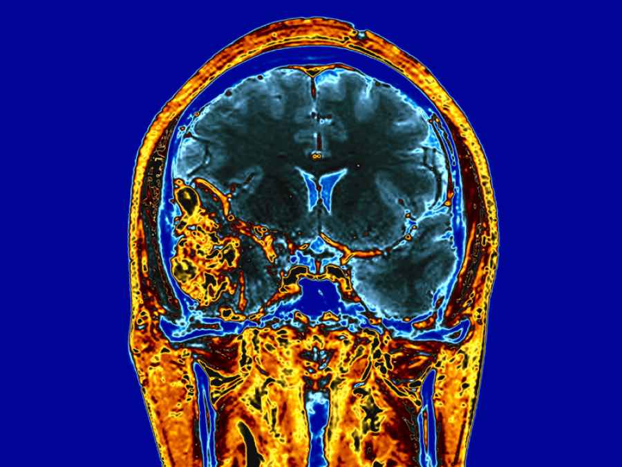 Gadolinio, el elemento podr&iacute;a hacer que la radioterapia solo act&uacute;e sobre c&eacute;lulas cancerosas