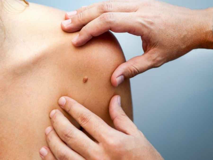 Conicet y Fundaci&oacute;n Sales desarrollaron una vacuna contra el melanoma