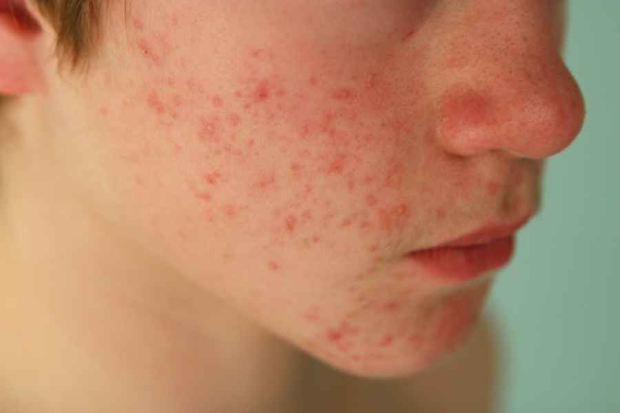 Aprueban la indicaci&oacute;n en adolescentes de medicamento para dermatitis at&oacute;pica severa